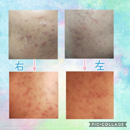 A アクネフォーム/NOV/洗顔フォームを使ったクチコミ(3枚目)