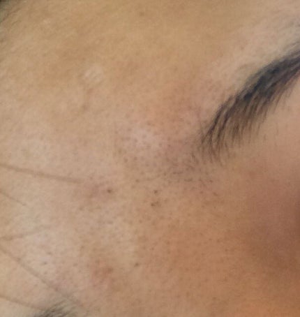 sparkle_perfume_yy8 on LIPS 「なにをやっても治らない…毛穴とニキビの悩みです。。中学生です。..」(2枚目)