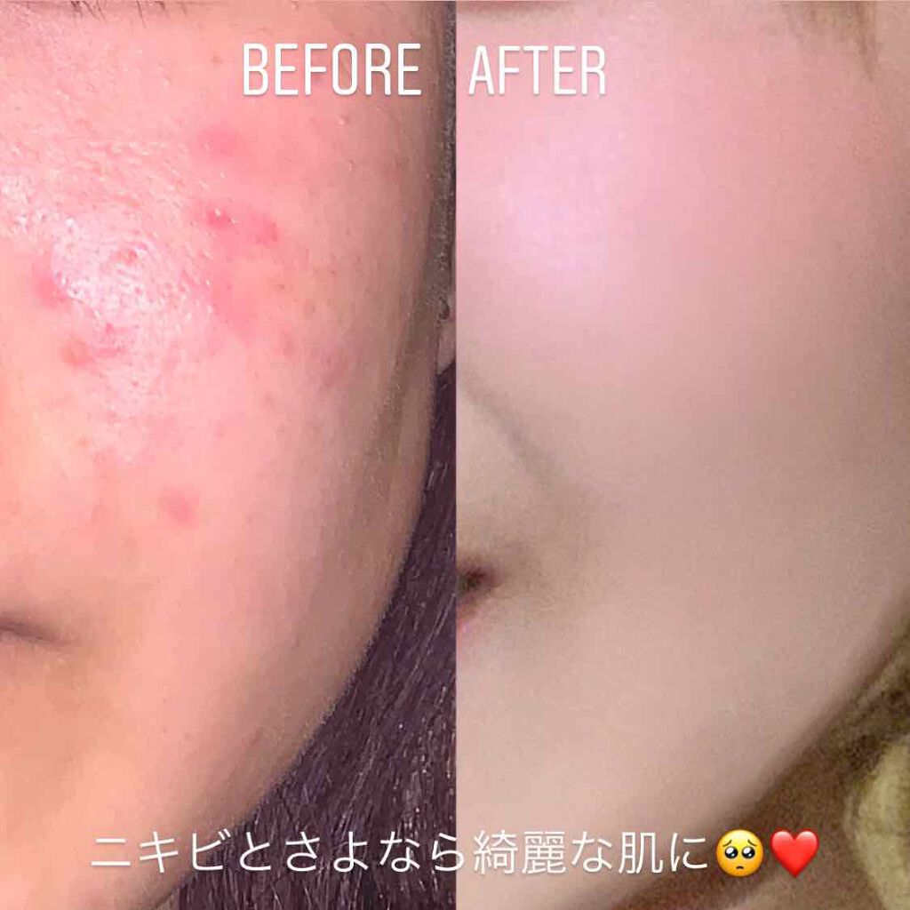 ハトムギ化粧水(ナチュリエ スキンコンディショナー R )/ナチュリエ/化粧水を使ったクチコミ(1枚目)