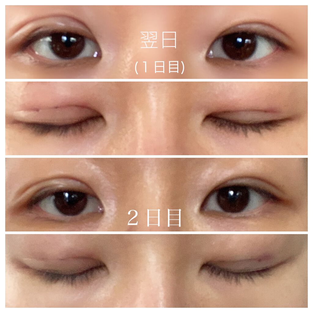 ソフトサンティア(医薬品)/参天製薬/その他を使ったクチコミ（2枚目）