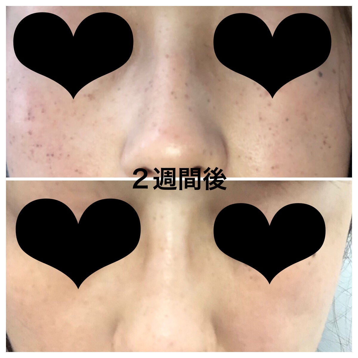 enu on LIPS 「シミ取り(ルメッカ)してきました〜❤︎.*ずーと悩んでいたシミ..」(2枚目)