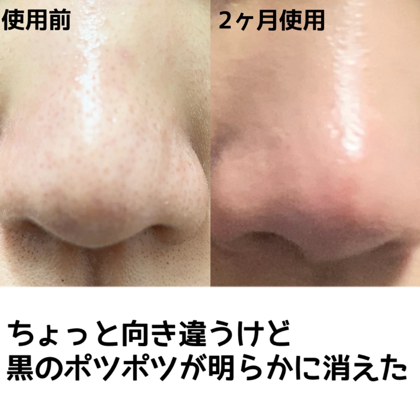 シカレチA エッセンス0.1/VT/美容液を使ったクチコミ(2枚目)