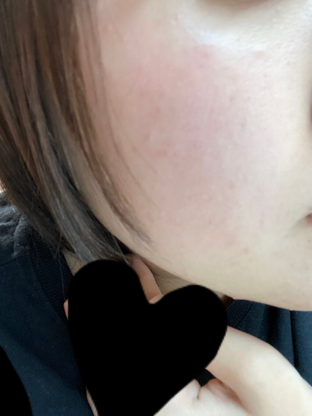 らりせ on LIPS 「閲覧注意です。今肌のニキビ跡?が気になって気になって仕方なくて..」(2枚目)