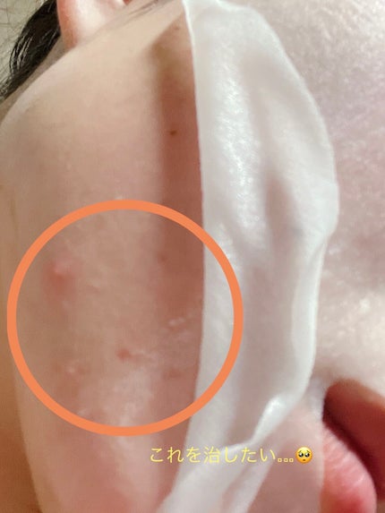 ごめんね素肌 キニナルマスク/クリアターン/シートマスク・パックを使ったクチコミ(6枚目)