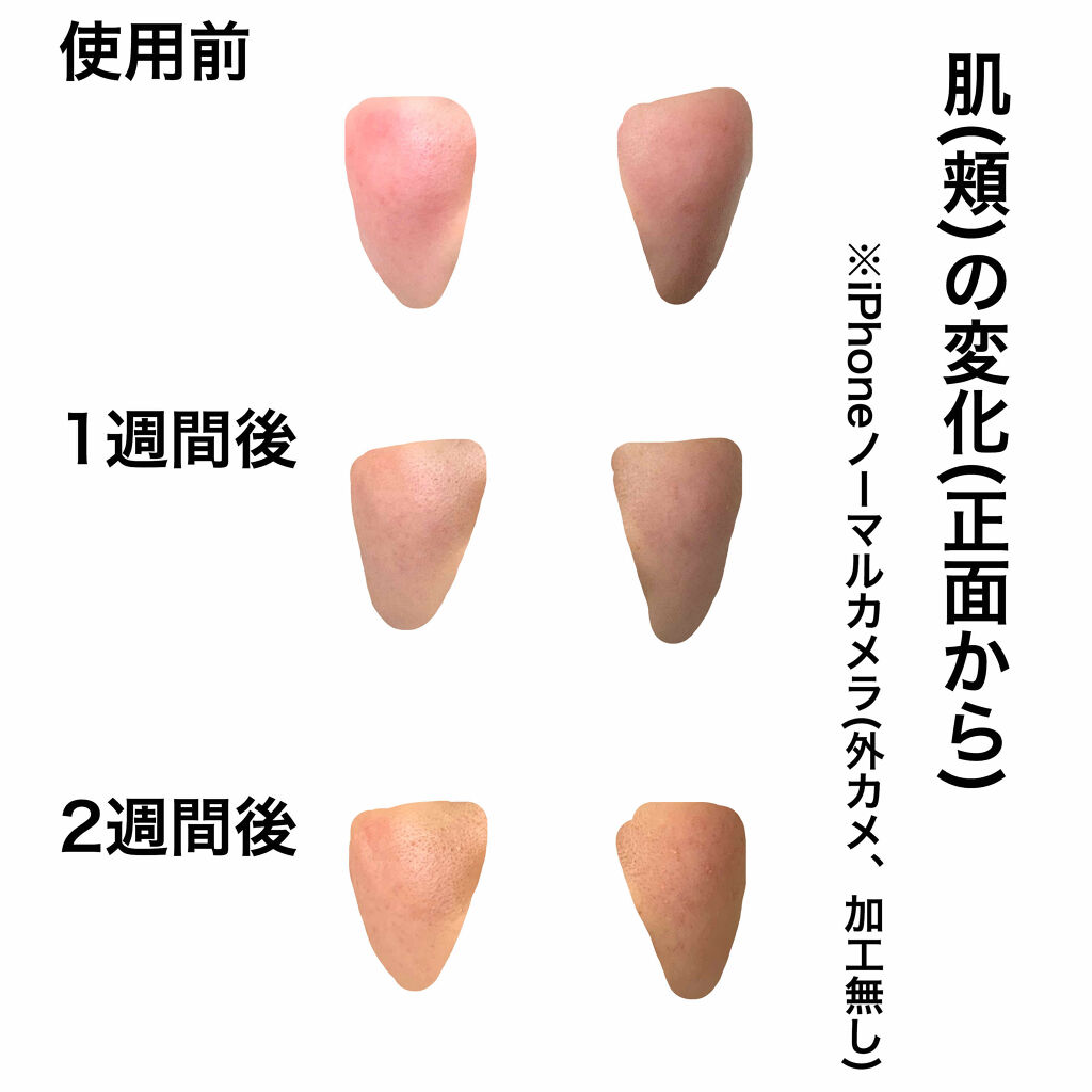 薬用 しみ 集中対策 美容液/メラノCC/美容液を使ったクチコミ（2枚目）