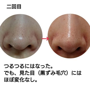 スーパーヴォルカニック ポアクレイマスク Innisfreeの効果に関する口コミ 毛穴日記 脱 いちご鼻 イニスフリースーパ By ふるゆき 混合肌 代前半 Lips