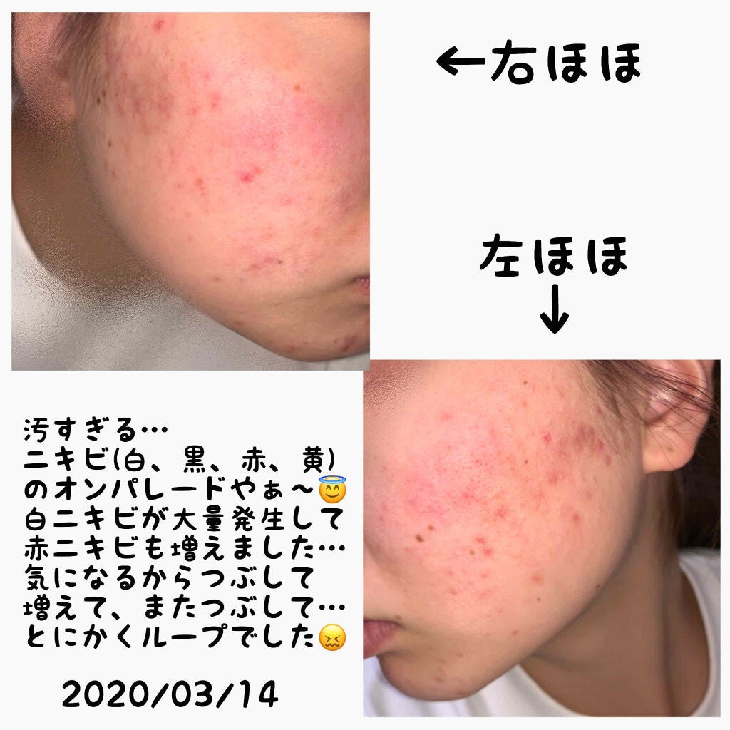 オードムーゲ 薬用ローション(ふきとり化粧水)/オードムーゲ/拭き取り化粧水を使ったクチコミ(2枚目)