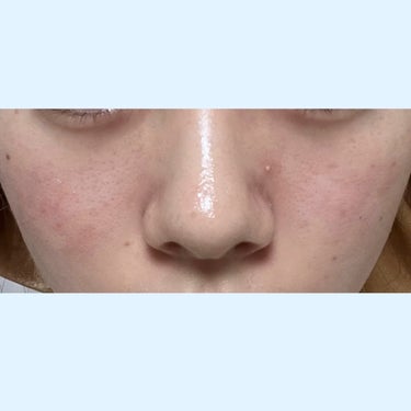 メラノCC ディープクリア酵素洗顔	のクチコミ「はじめまして。
私は現在高校2年生です🎀

2.3年程前から、肌の事(毛穴・にきび跡・肌.....」（2枚目）
