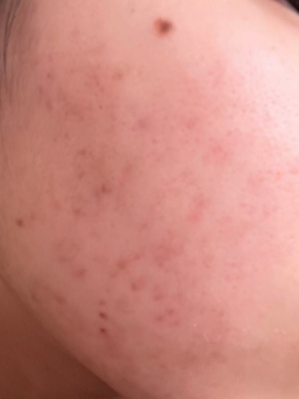 ニキビJK on LIPS 「汚肌からお肌への道!!9週間目!!今回のこの写真はホントに起き..」(2枚目)