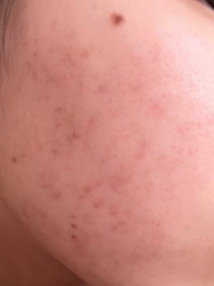 ニキビJK on LIPS 「汚肌からお肌への道!!9週間目!!今回のこの写真はホントに起き..」(2枚目)