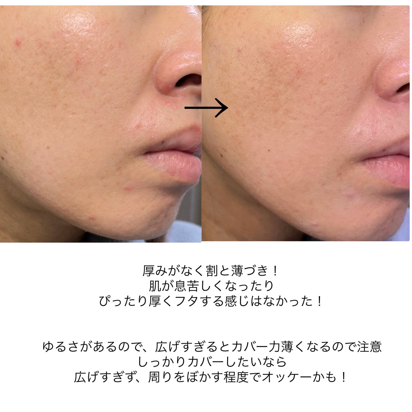 薬用スポットシーラークリーム/スキンヒーロー/クリームコンシーラーを使ったクチコミ(5枚目)
