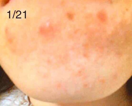 薬用クリーム/ニキビケア/フェイスクリームを使ったクチコミ(4枚目)