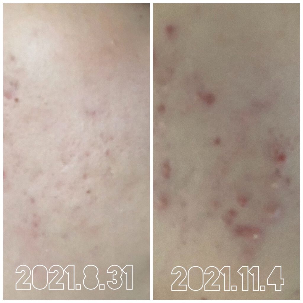 メナード TK クリーム 無香料のクチコミ「(自分のメモです)

一時期ここまで治まったのに今これって…
何なんですかね…

どう考えても.....」（1枚目）