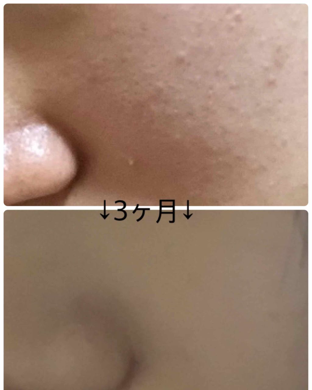 オードムーゲ 薬用ローション(ふきとり化粧水)/オードムーゲ/拭き取り化粧水を使ったクチコミ(2枚目)