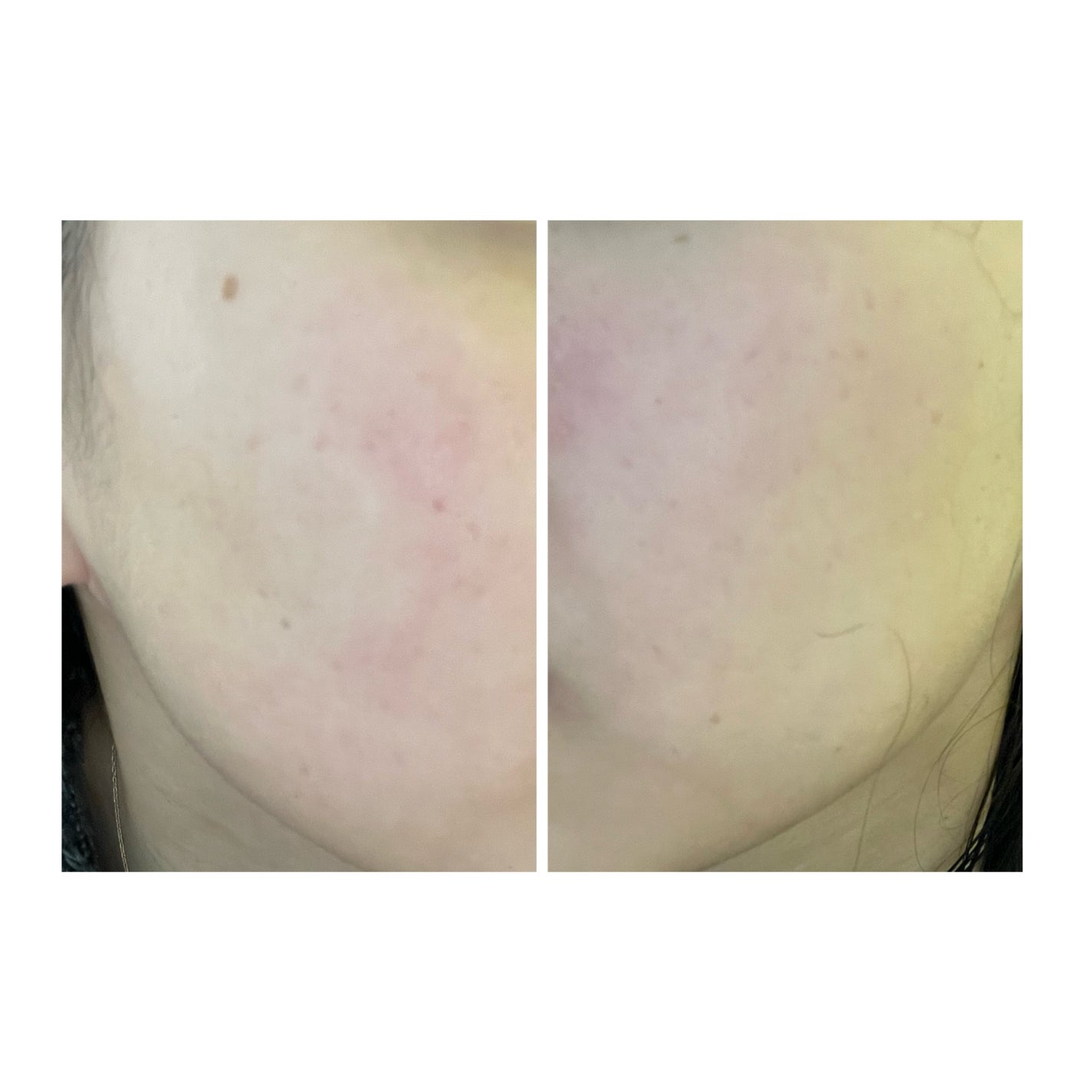 ぽむ on LIPS 「2023.9.13皮膚科に受診 エピデュオとヘパリン処方1枚目..」(2枚目)