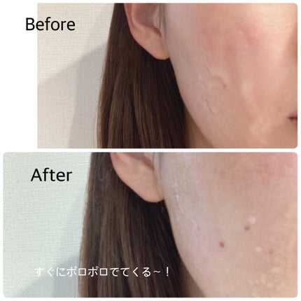 DETクリア ブライト&ピール ピーリングジェリー<無香料タイプ>/Detclear/ピーリングを使ったクチコミ(6枚目)