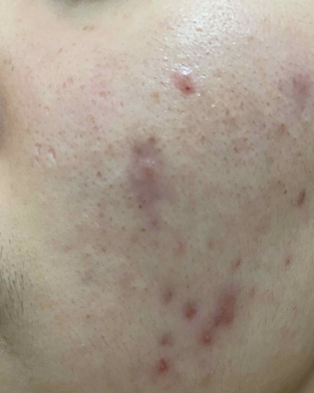 FDR アクネケア 洗顔クリーム/ファンケル/洗顔フォームを使ったクチコミ（3枚目）