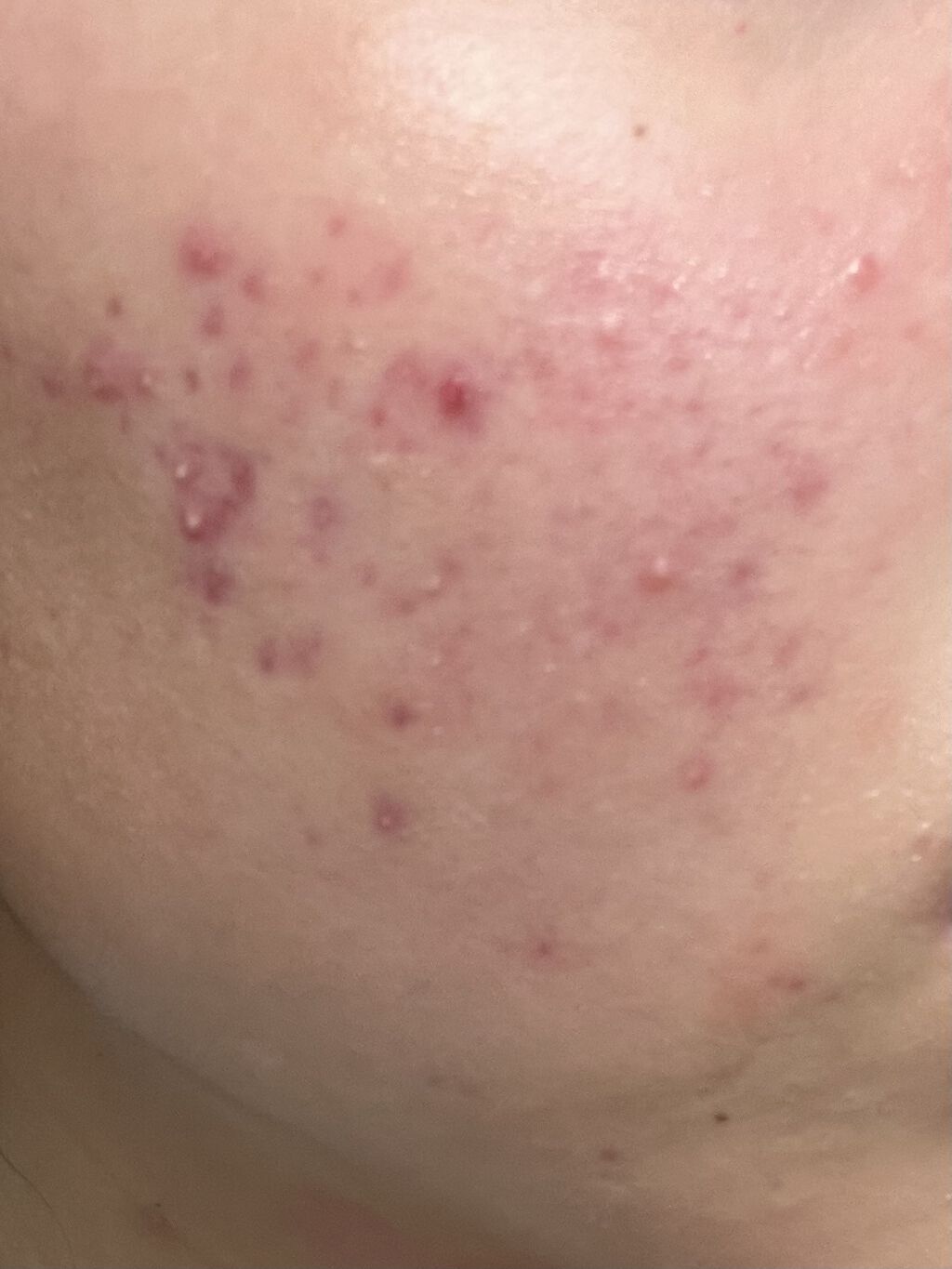 アクアチムローション、アクアチムクリーム(医薬品)/大塚製薬/その他を使ったクチコミ（2枚目）