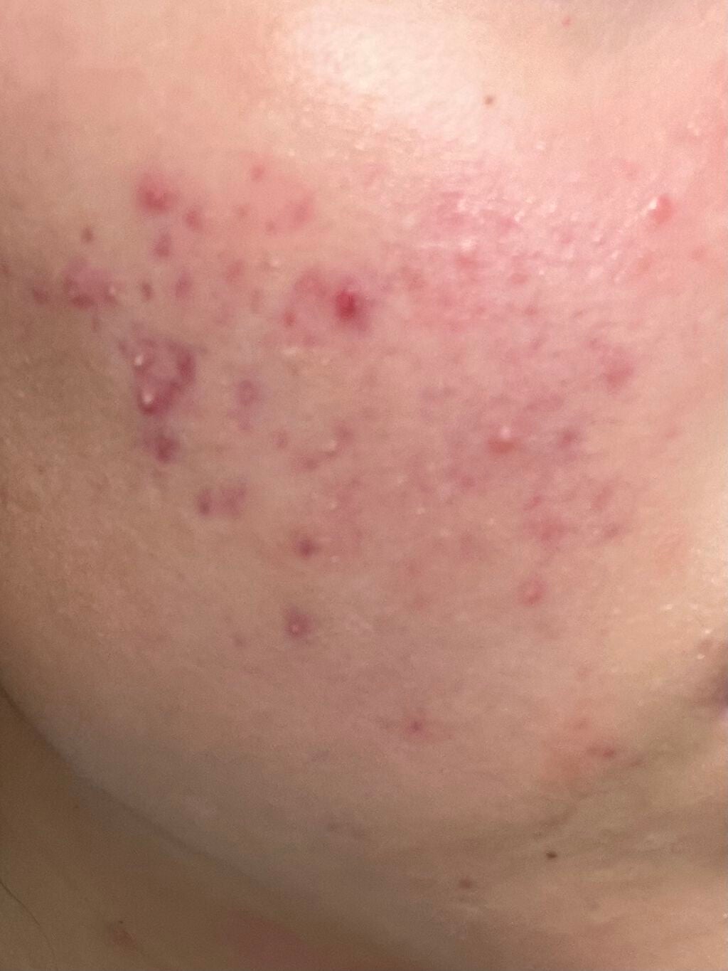 プラス on LIPS 「金曜に皮膚科行ってまたまた青色LED受けてきました〜そして、前..」(2枚目)