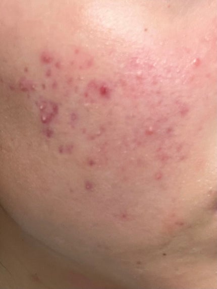 アクアチムローション、アクアチムクリーム(医薬品)/大塚製薬/その他を使ったクチコミ(2枚目)