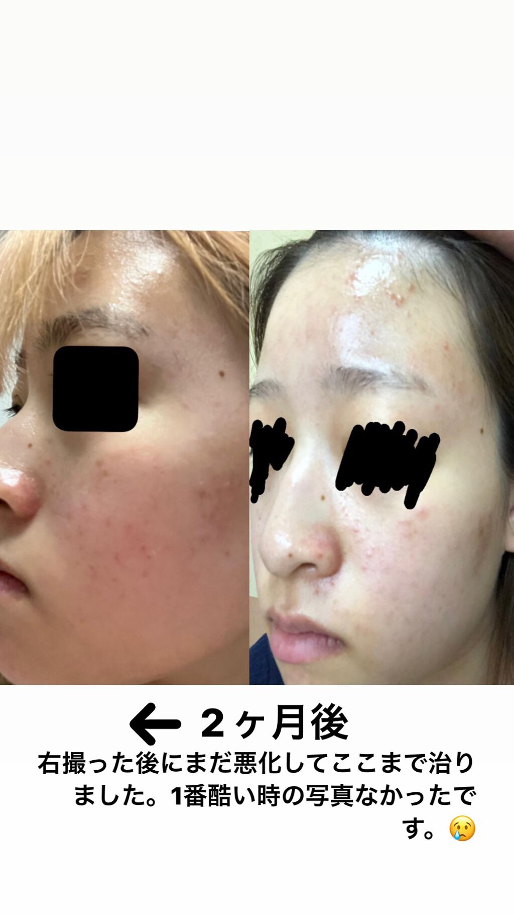 薬用しみ対策 美白化粧水 しっとりタイプ/メラノCC/化粧水を使ったクチコミ（1枚目）