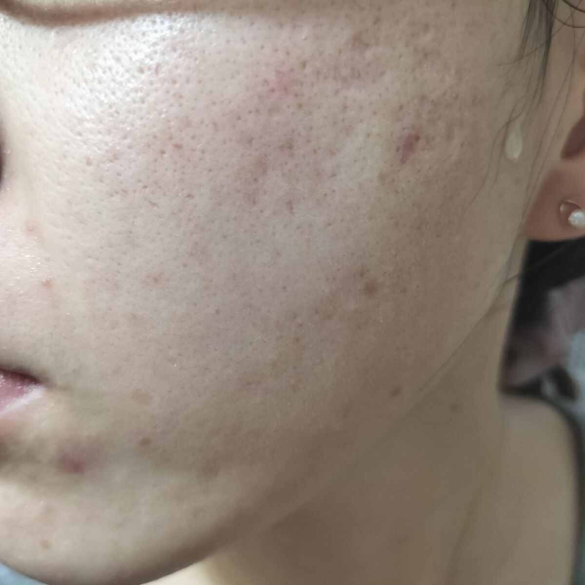 100LAAインパウダー/The Ordinary/その他スキンケアを使ったクチコミ（2枚目）