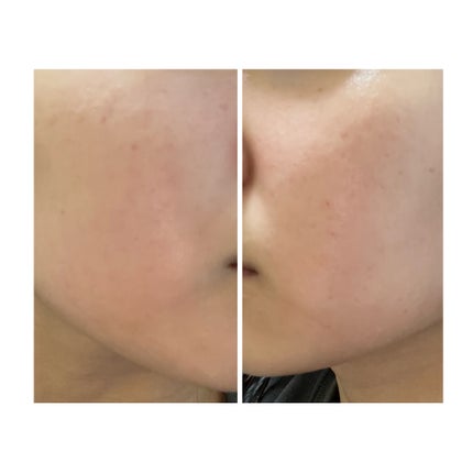 ぽむ on LIPS 「2023.9.13皮膚科に受診 エピデュオとヘパリン処方1枚目..」(2枚目)