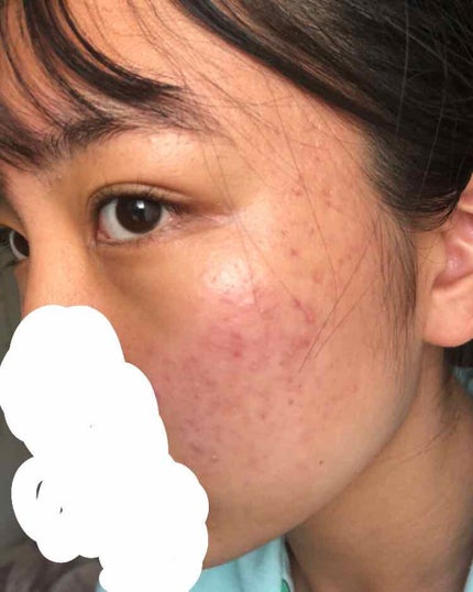 マスキング レイアリング アンプル エクセルトーニングショット/MEDIHEAL/美容液を使ったクチコミ(1枚目)