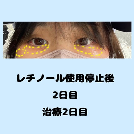 レチノールインテンシブ アドバンスドトリプルアクションアイクリーム/SOME BY MI/アイケア・アイクリームを使ったクチコミ(5枚目)