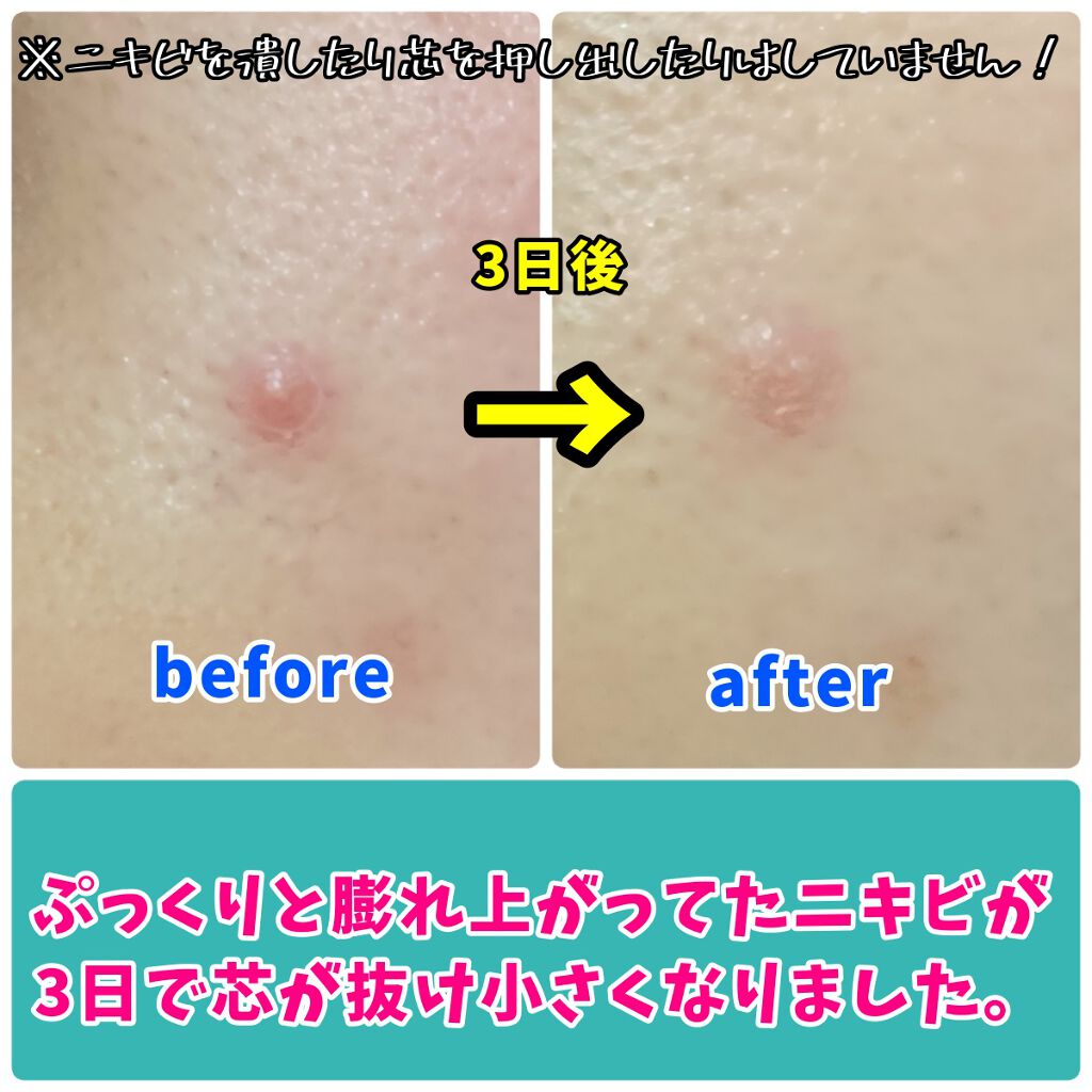 オートマトン 白内障 見習い ヴァセリン ニキビ アクロバット 十億 求める