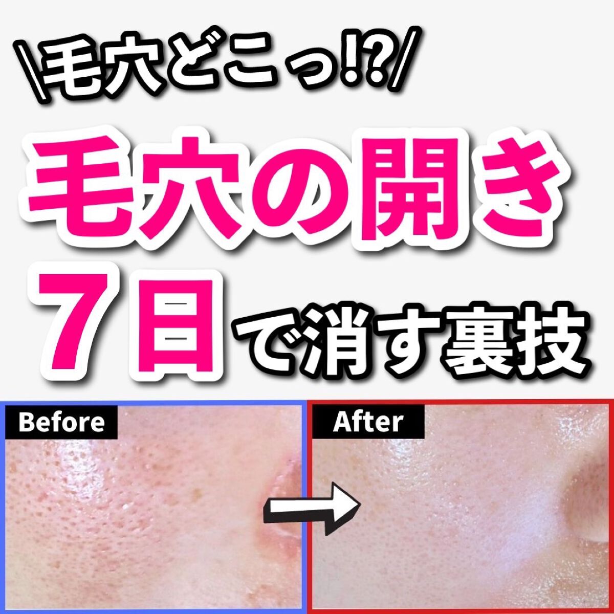 あなたの肌に合ったスキンケア💐コーくん先生 on LIPS 「【1割しか知らない裏技】たった7日で毛穴の開きを消す方法.
...」(1枚目)