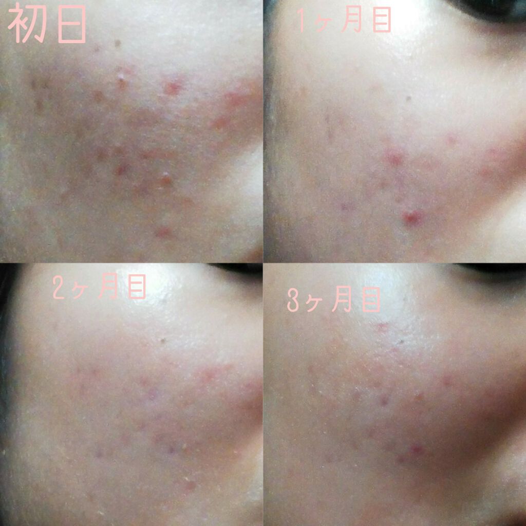 ペアアクネクリームW(医薬品)/ペア/その他を使ったクチコミ（2枚目）