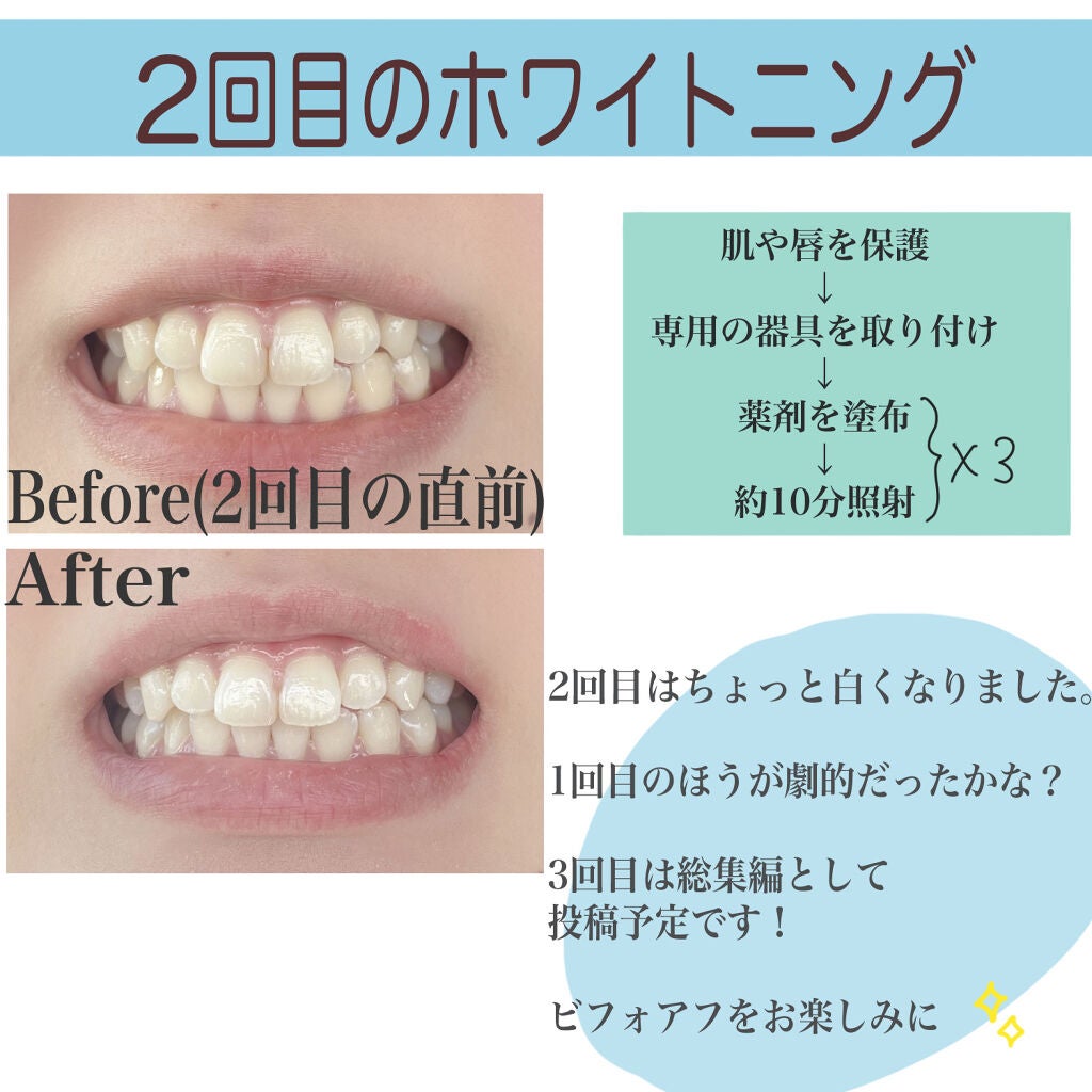 さくま on LIPS 「さくまと申します☻ついにオフィスホワイトニングが完了しましたの..」(5枚目)