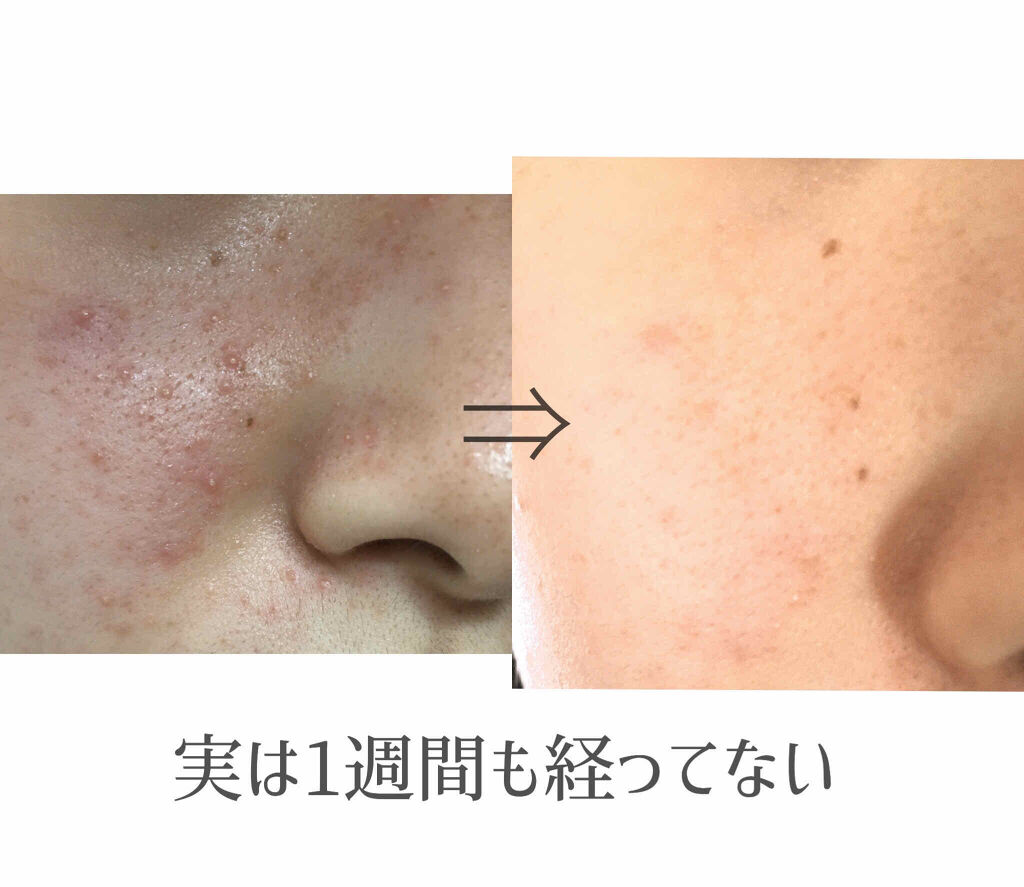 試してみた ドルマイコーチ軟膏 医薬品 ゼリア新薬工業 Lips