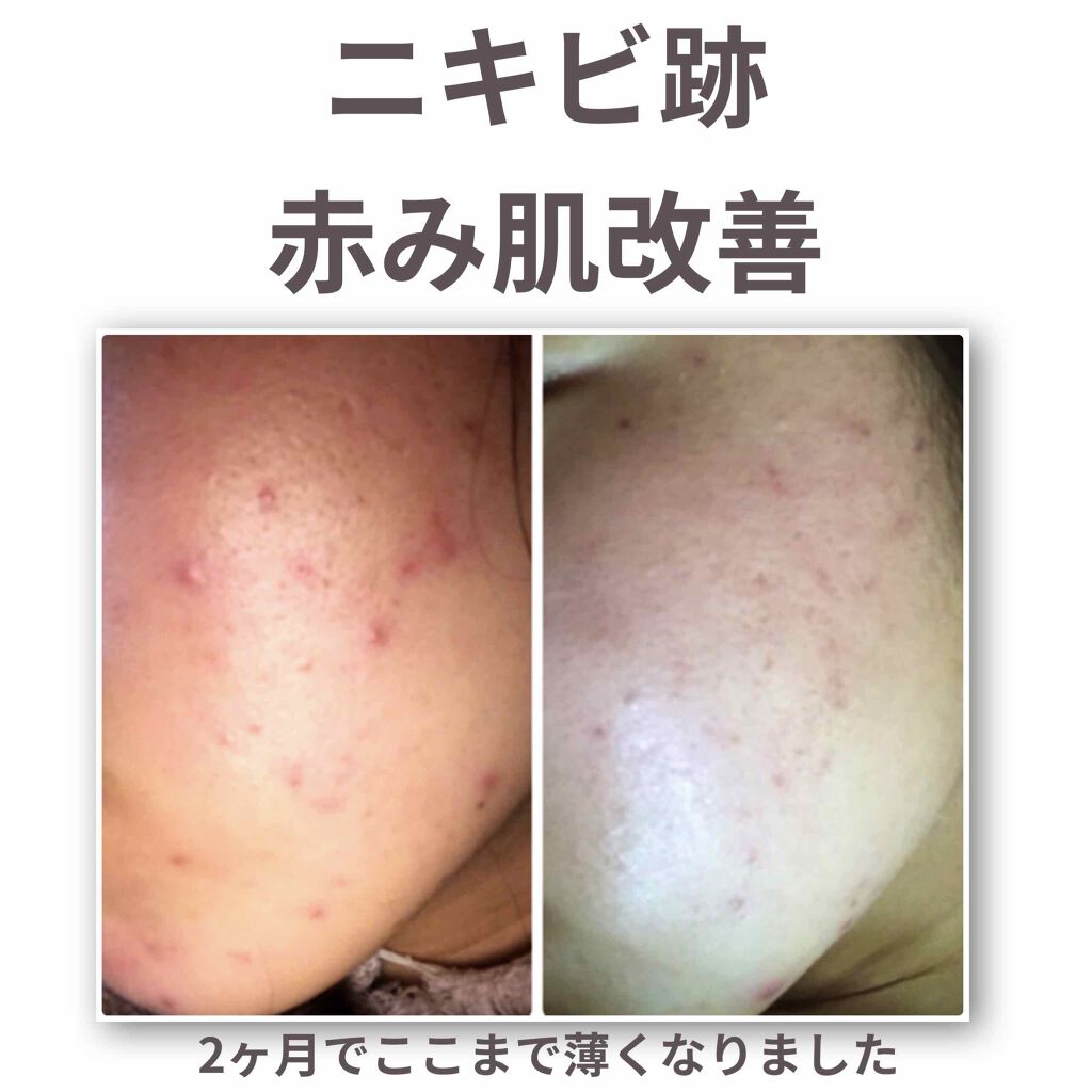 スキンケア方法 薬用しみ対策 保湿クリーム メラノccの使い方 効果 ニキビ跡 赤み肌 By つぶみ 脂性肌 代前半 Lips