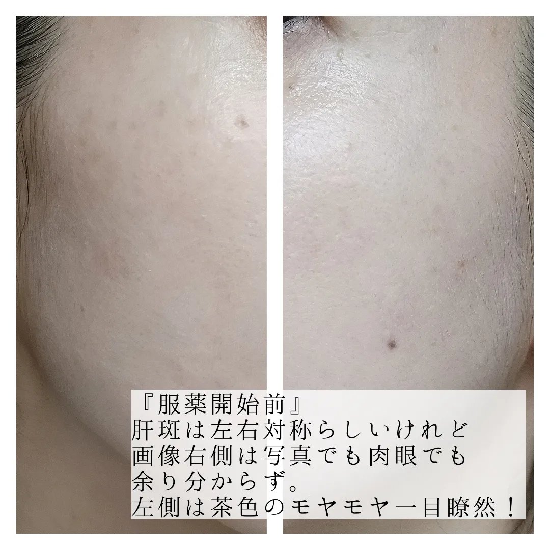 トランシーノII (医薬品)/トランシーノ/その他を使ったクチコミ（3枚目）