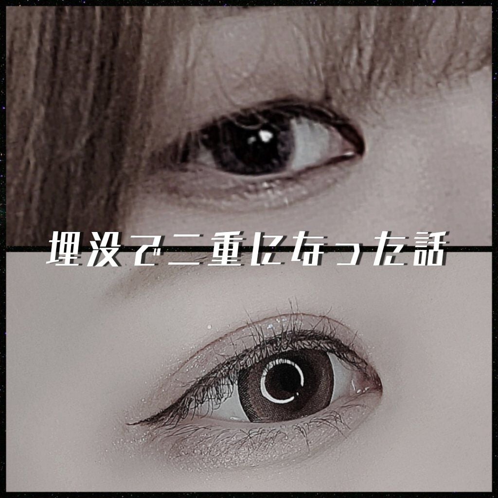 m. on LIPS 「埋没で二重になった話🦋/こんにちは𓆈今回は1か月前に埋没を行い..」(1枚目)