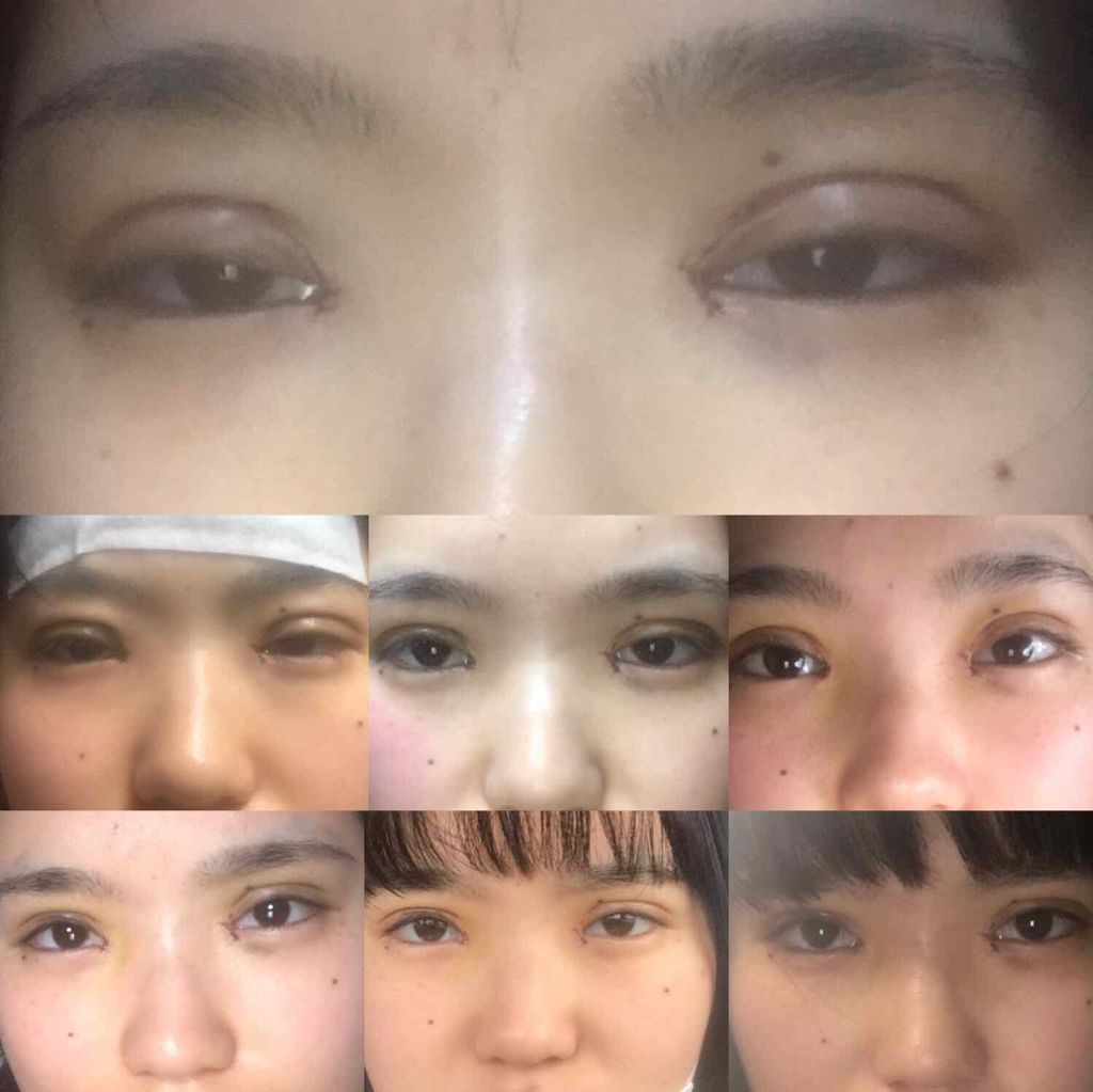 (仮) on LIPS 「こんにちは、(仮)です!今回は二重整形についてお話しします!私..」(3枚目)