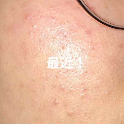 A アクネフォーム/NOV/洗顔フォームを使ったクチコミ(3枚目)