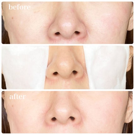 ピンクティーツリートナー/APLIN/化粧水を使ったクチコミ(3枚目)