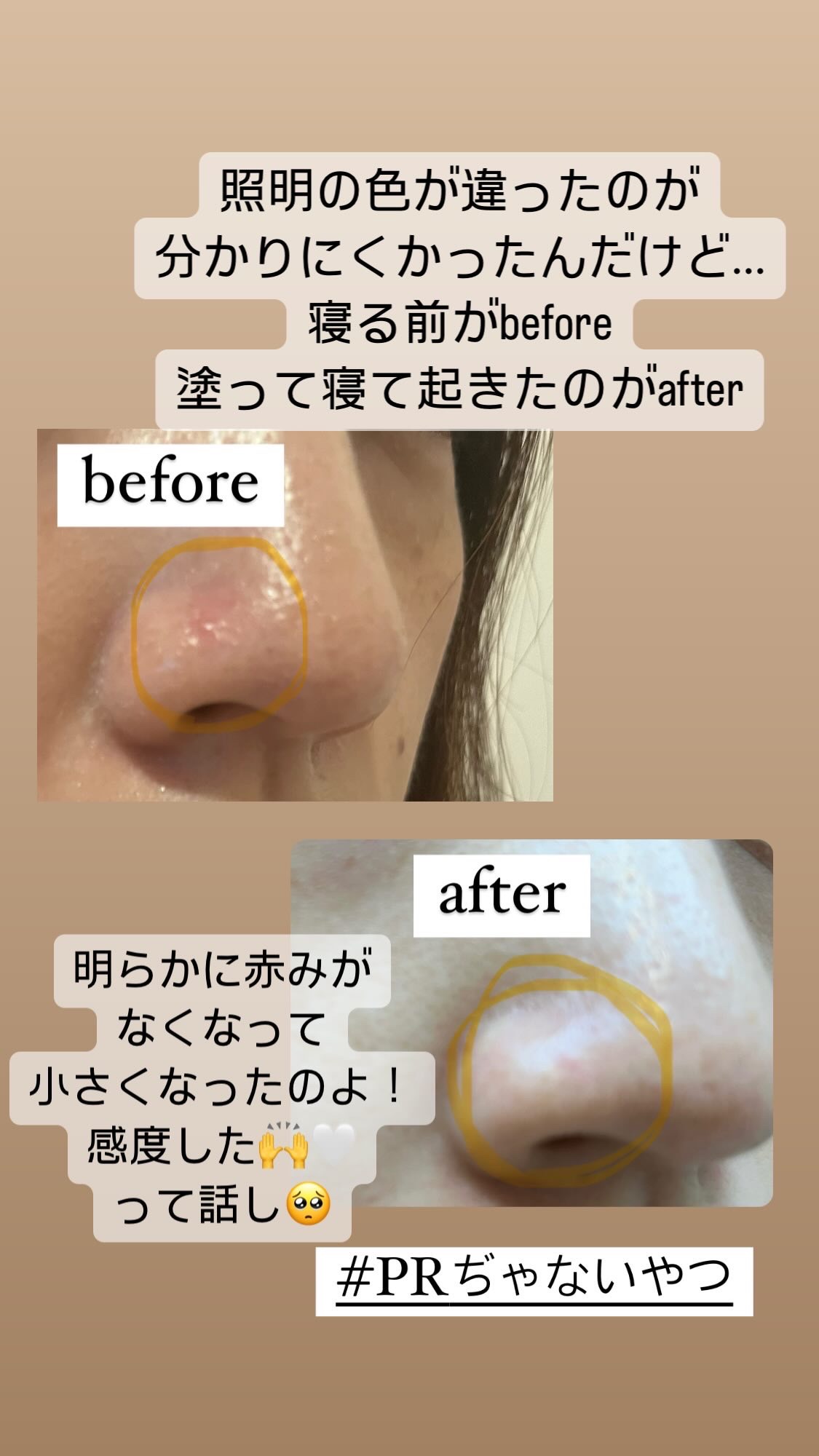 薬用 アクネケア美容液/d プログラム/美容液を使ったクチコミ（2枚目）