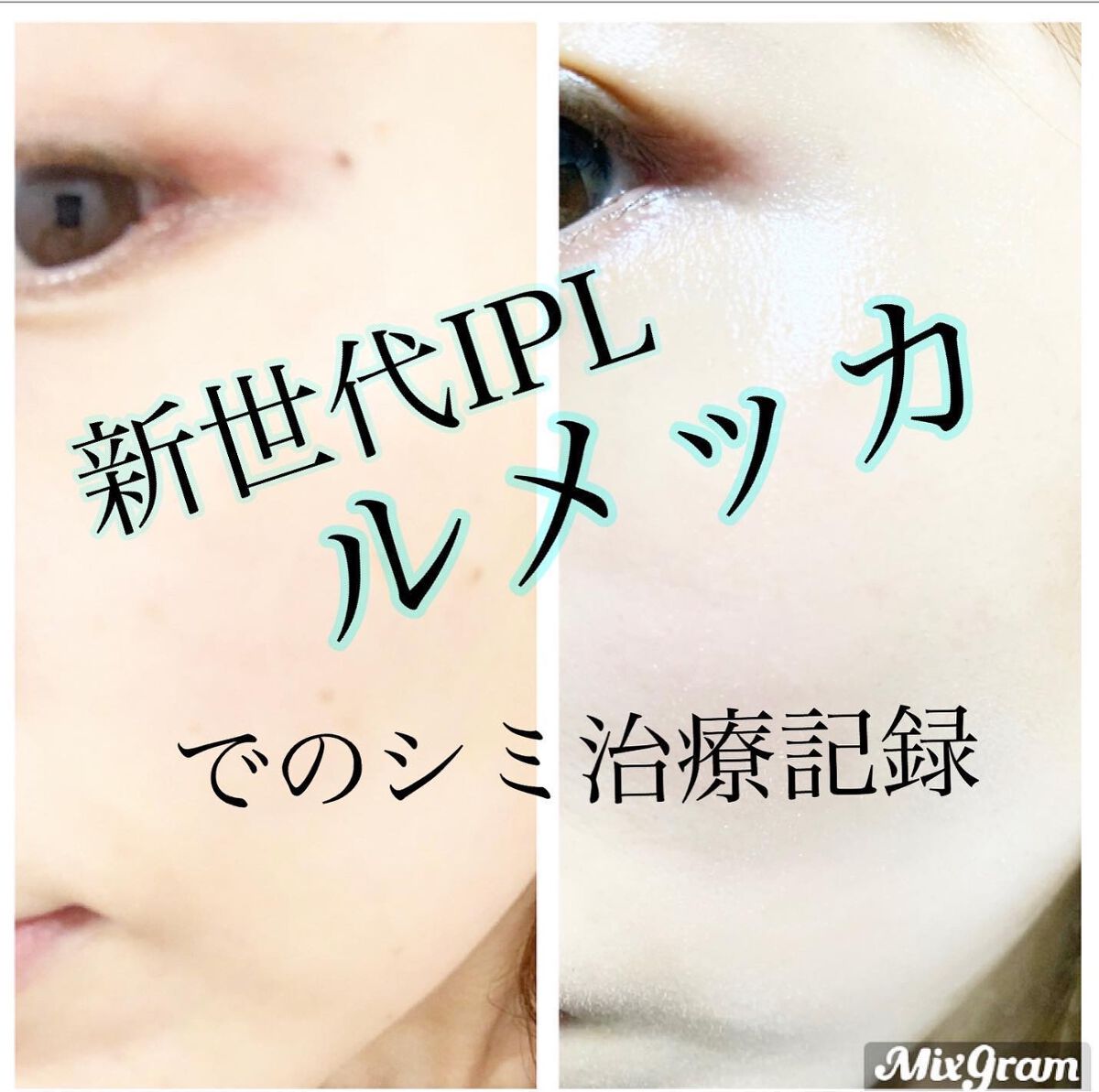 mipo1212ð€ on LIPS ãâšâšæ°äžä»£IPLã«ã¡ãã«ãŠãã·ãæ²»çããããŠã¿ãææ³âšâšï»¿ï»¿ï»¿..ãïŒ1æç®ïŒ