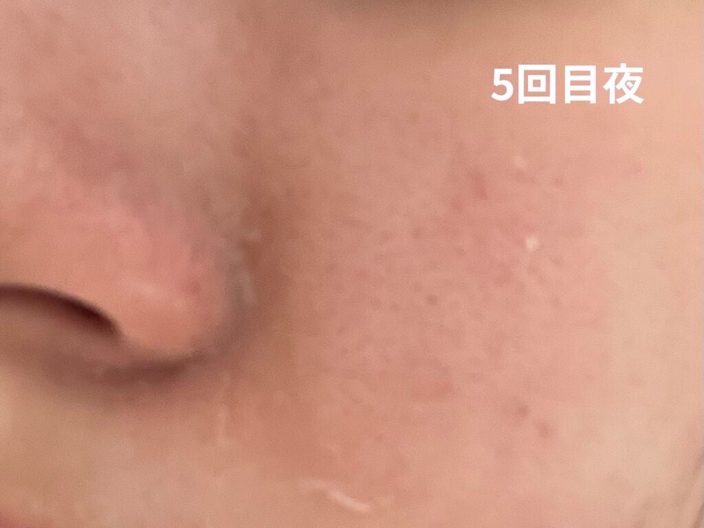 レチノールA 1% アドバンスドリバイタリゼーションクリーム/Life-flo/フェイスクリームを使ったクチコミ(3枚目)