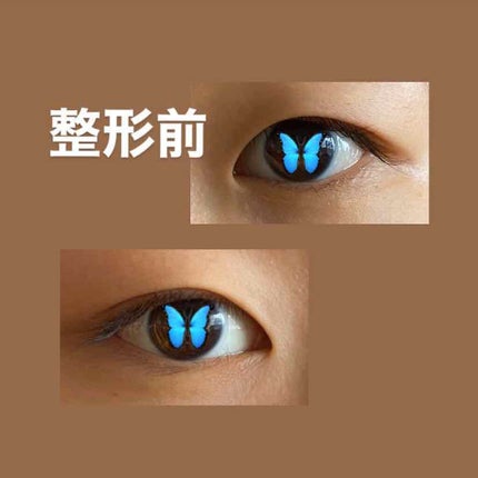 二重整形/その他を使ったクチコミ(2枚目)