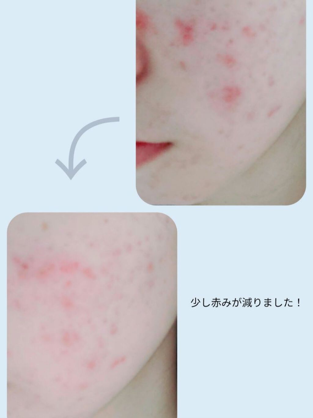 チョコラBBプラス (医薬品)/チョコラBB/その他を使ったクチコミ（3枚目）