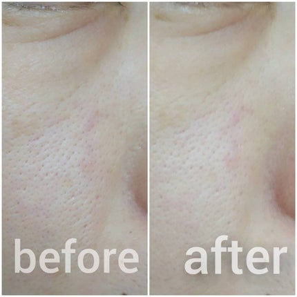 ティーツリーカーミングエッセンスパッド/MEDIHEAL/トナーパッドを使ったクチコミ(8枚目)