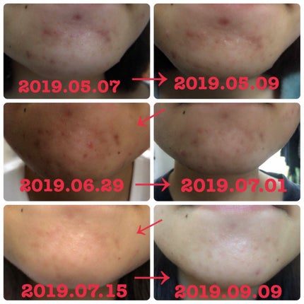 十味敗毒湯 ジュウミハイドクトウ(医薬品)/クラシエ薬品/その他を使ったクチコミ(4枚目)