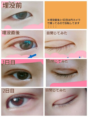 みっくす！ on LIPS 「【施術1週間後の写真も追加しました！】私の二重整形についてお話..」（2枚目）