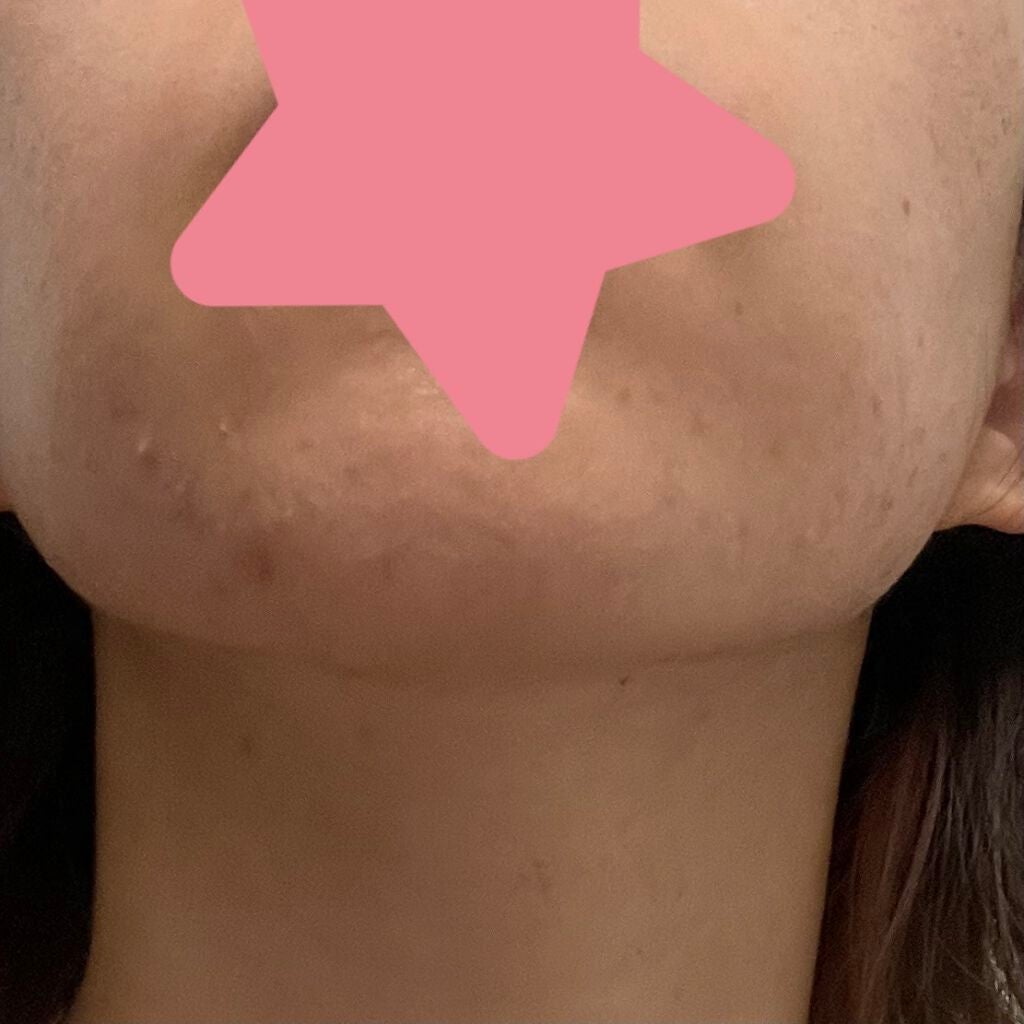 アポスティークリーム(医薬品)/アポスティー/その他を使ったクチコミ(4枚目)