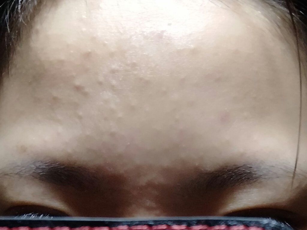 ペアアクネクリームW(医薬品)/ペア/その他を使ったクチコミ（1枚目）